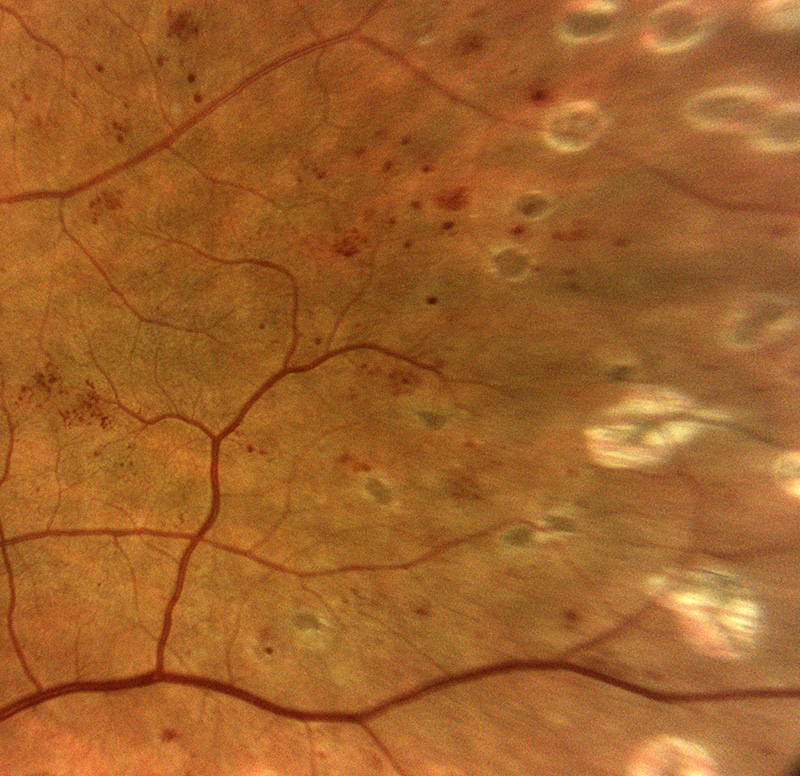 Netzhautver%C3%A4nderungen%20bei%20diabetischer%20Retinopathie